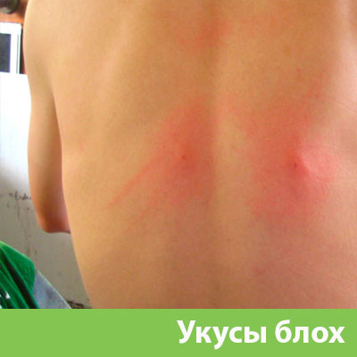 Укусы блох в Астрахани