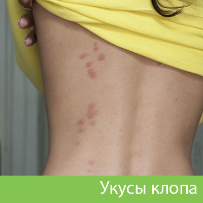 Профессиональное уничтожение клопов в Астрахани